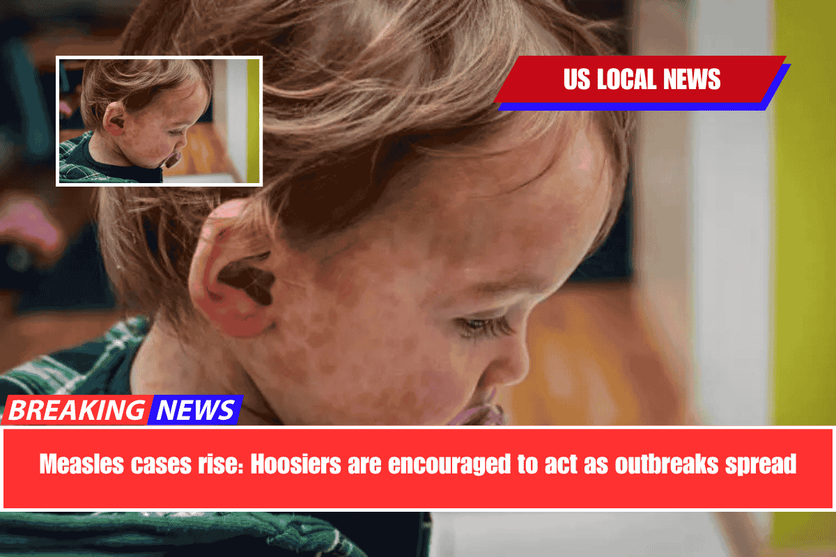 Measles cases rise Hoosiers are encouraged to act as outbreaks spread