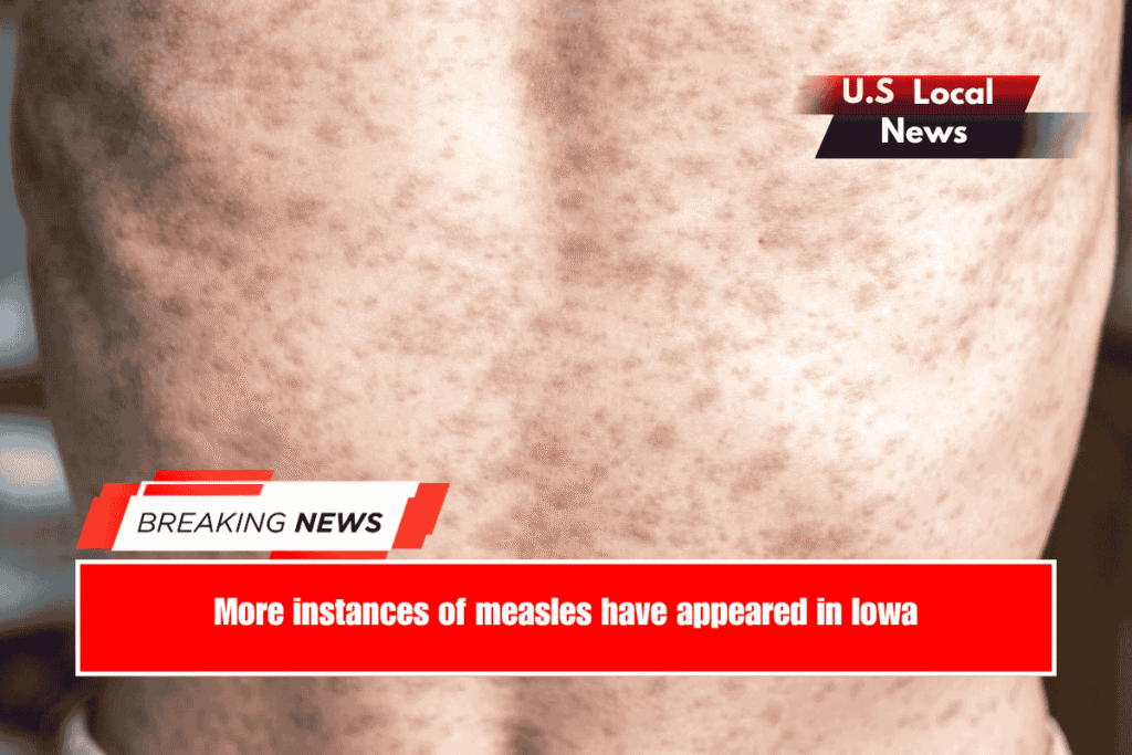 More instances of measles have appeared in Iowa